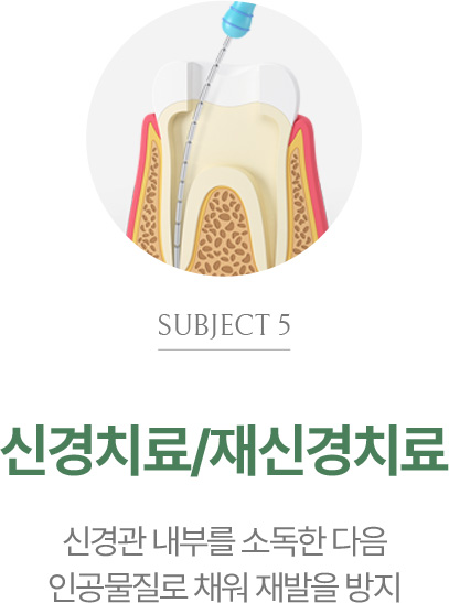 신경치료/재신경치료