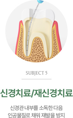 신경치료/재신경치료