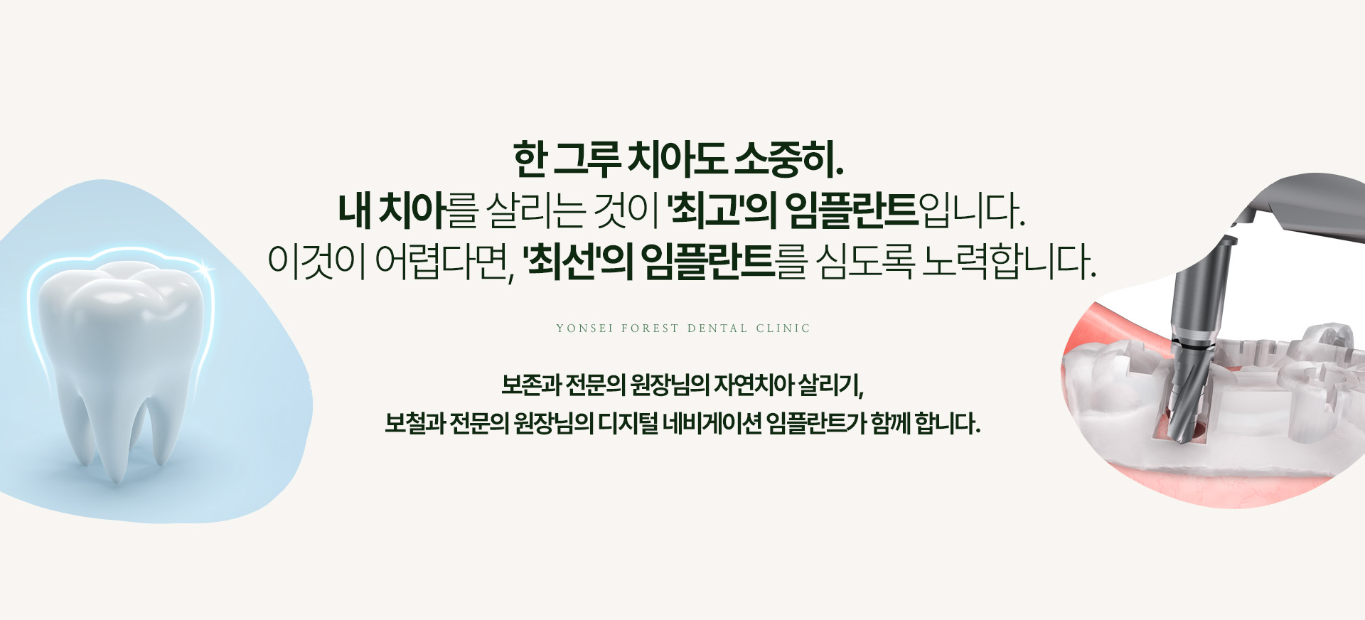 한그루 치아도 소중히. 내 치아를 살리는 것이 '최고'의 임플란트입니다. 이것이 어렵다면, '최선'의 임플란트를 심도록 노력합니다.